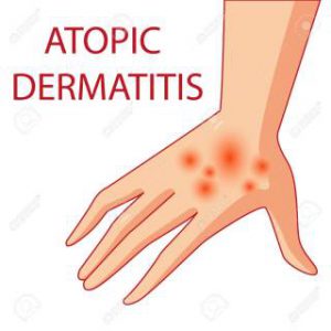 illustration of atopic dermatitis. allergies. dermatology. inflammation